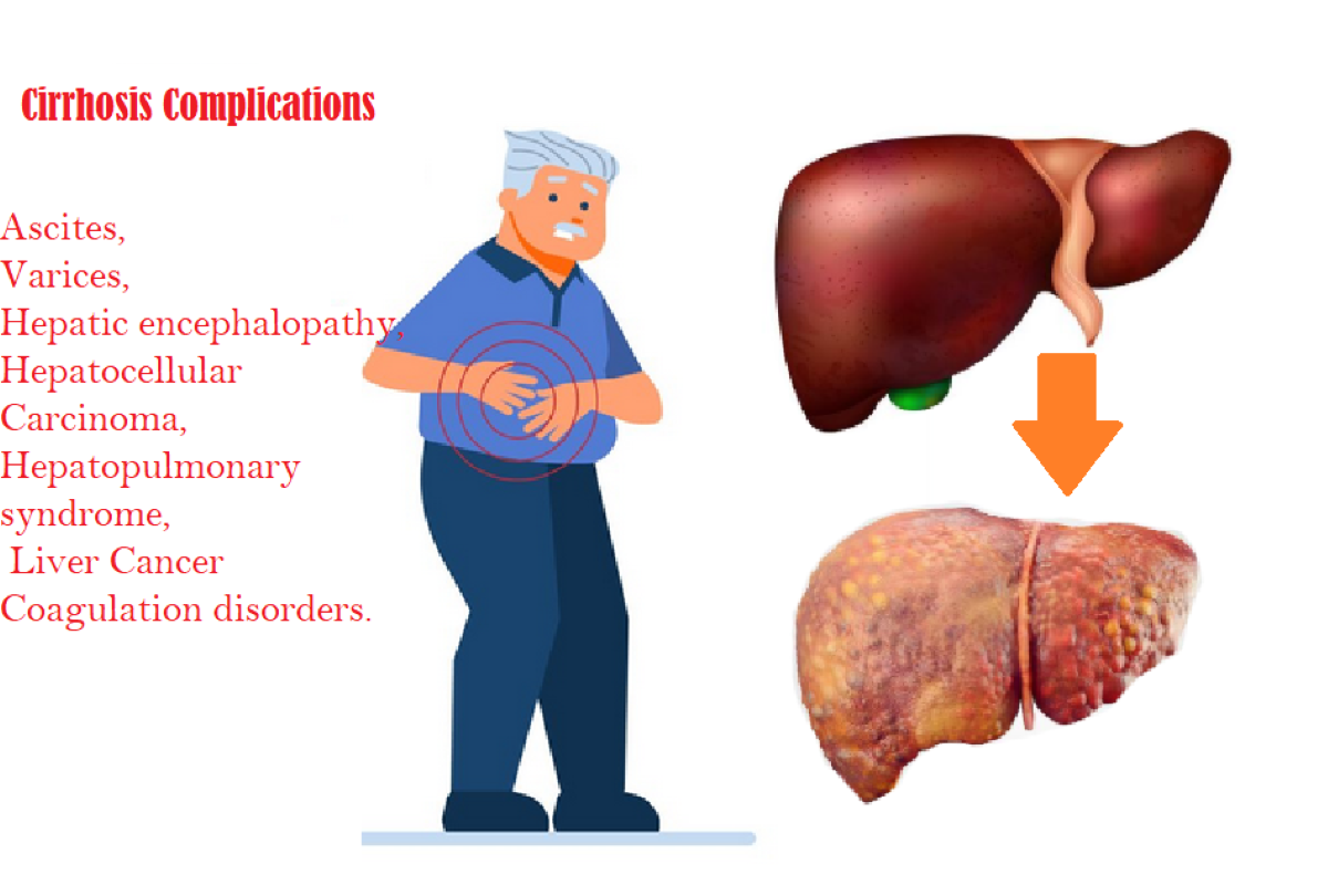 What Complications Arise from Cirrhosis and How Can They Be Managed?