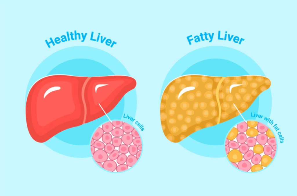 The Connection Between Obesity and Liver Health